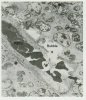 Tissue bubble rupturing into capillary smaller.jpg Tissue bubble rupturing into capillary smaller.jpg